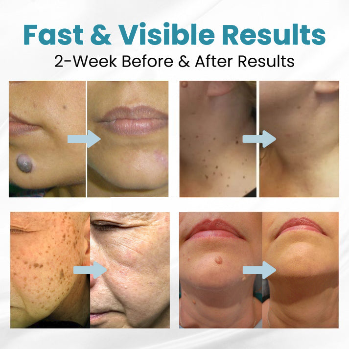 Natravor™ Non-Invasive Mole and Wart Removal Laser Pen